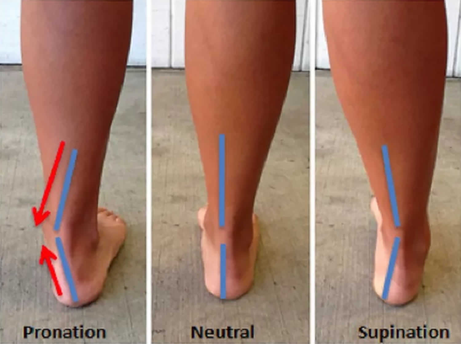 foot pronation vs supination