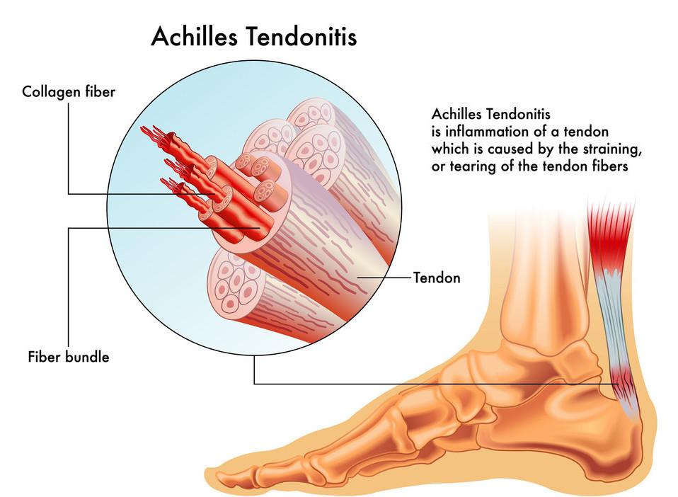 how can ahilles tendonitis be prevented