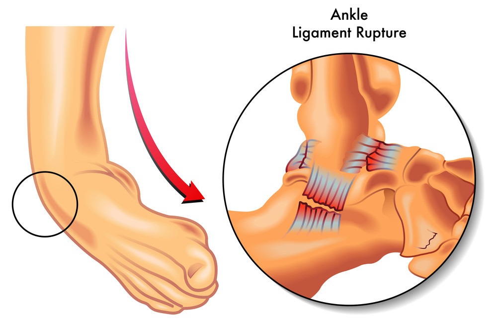 How to Heal a Torn Ankle Ligament Fast?