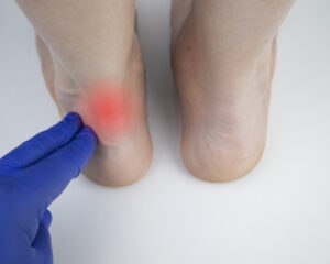 Achilles Tendonitis